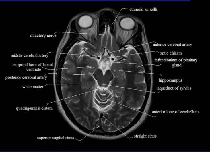 cross-sectional-anatomy-mri-brain