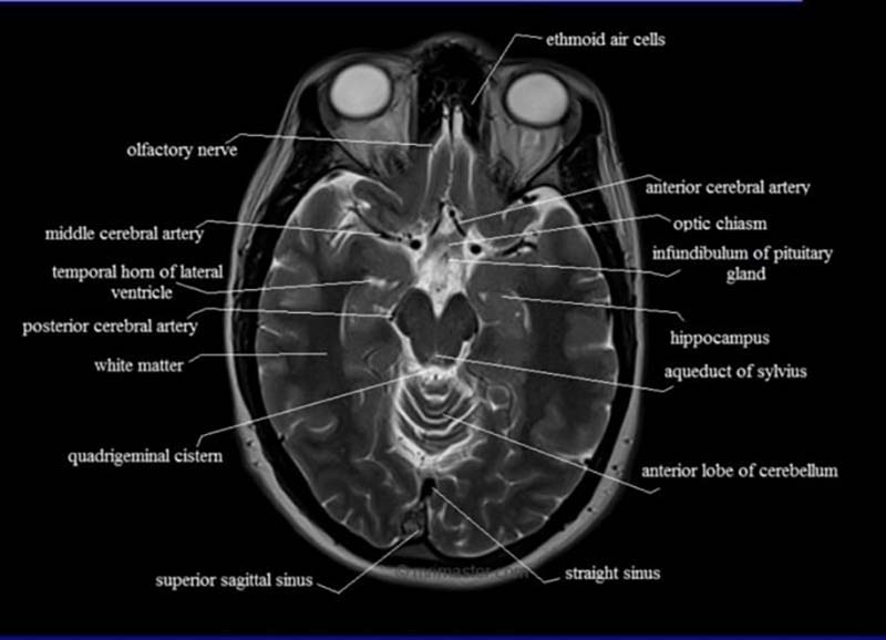 cross-sectional-anatomy-mri-brain